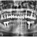 Implantes dentales. Complicaciones