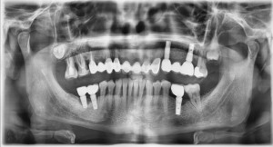 Radiografía dental con implantes | Clínica dental | Carillas | ortodoncia invisible | Larrañaga