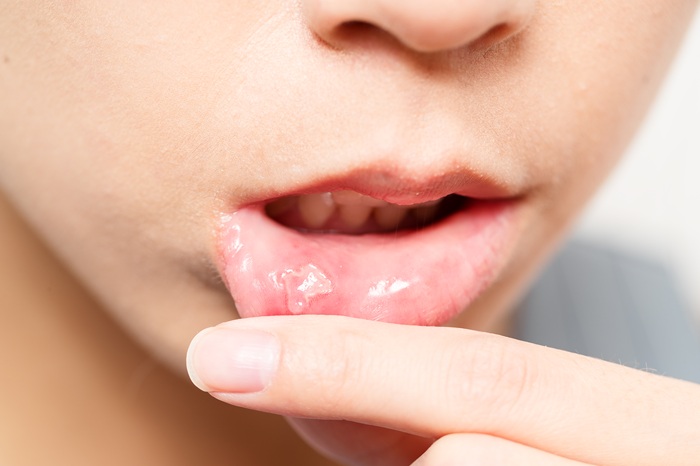 Llagas en la boca: por qué aparecen y cuándo consultar al dentista