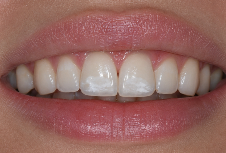 Infiltración para manchas blancas en los dientes: una técnica mínimamente invasiva