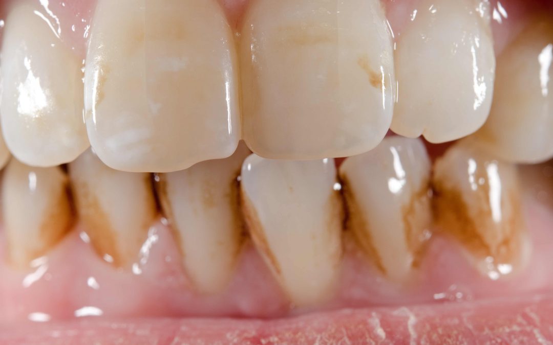 Arashigaoka Noveno Escabullirse manchas en los dientes - Clínica Dental Larrañaga