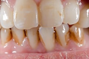 manchas en los dientes | Dentista Legazpi | Clínica dental infantil | Mejores implantes dentales