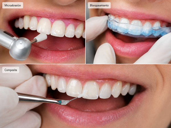 Imagen mostrando tratamiento de microabrasión, blanqueante y composite | Manchas Blancas en los Dientes | Clínica Dental en Madrid Río