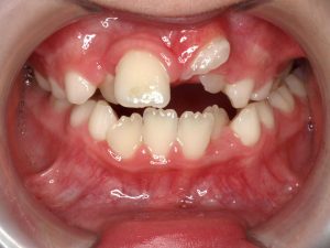 paladar estrecho | Dentista Legazpi | Clínica dental infantil | Mejores implantes dentales