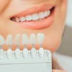 Carillas estéticas: cómo mejoran la sonrisa de manera sencilla