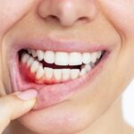 Cuidado de las encías: la importancia de una buena salud periodontal