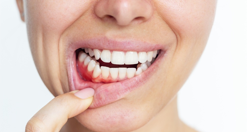 Cuidado de las encías: la importancia de una buena salud periodontal