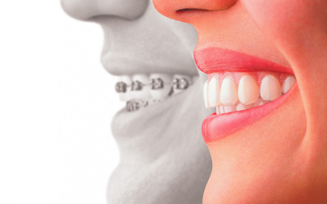 Tipos de ortodoncia invisible en el Sistema Invisalign