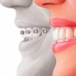 Tipos de ortodoncia invisible en el Sistema Invisalign