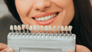 Mujer con una guía de tonos dentales | blanqueamiento dental | Estética dental | Clinica dental Madrid | Clinica dental Larrañaga