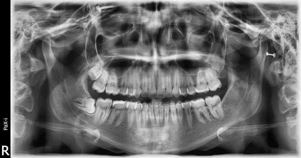 cirugia-maxilofacial-de-la-muela-del-juicio