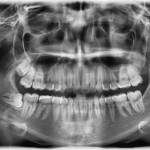 Cirugía maxilofacial de la muela del juicio