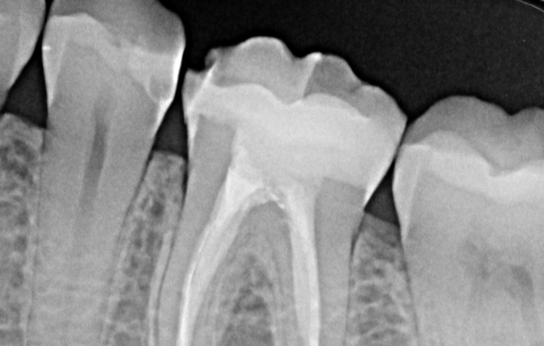 Dolor después de una endodoncia