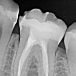 Dolor después de una endodoncia