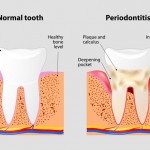 Periodontitis: síntomas