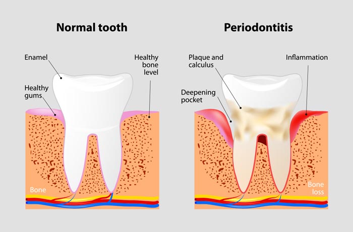 Cirugía Periodontal