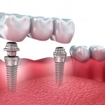Colocación de un implante dental paso a paso