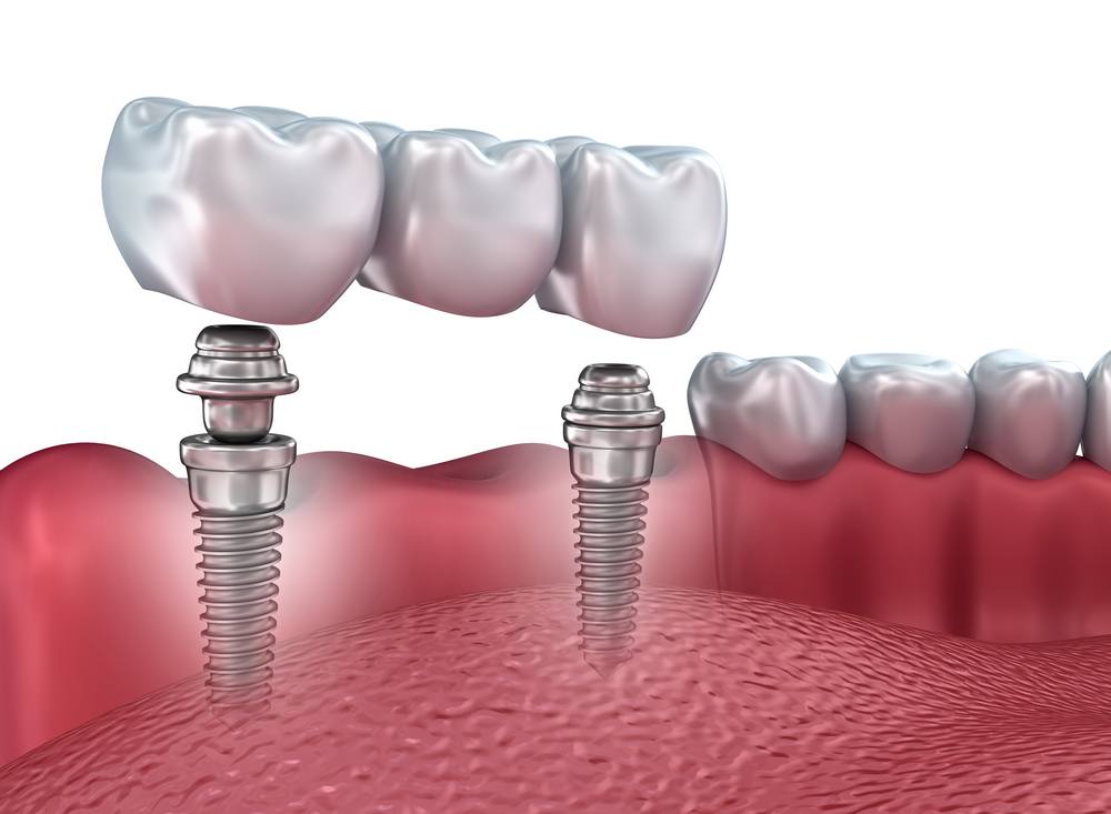 ¿cuánto dura un implante dental?