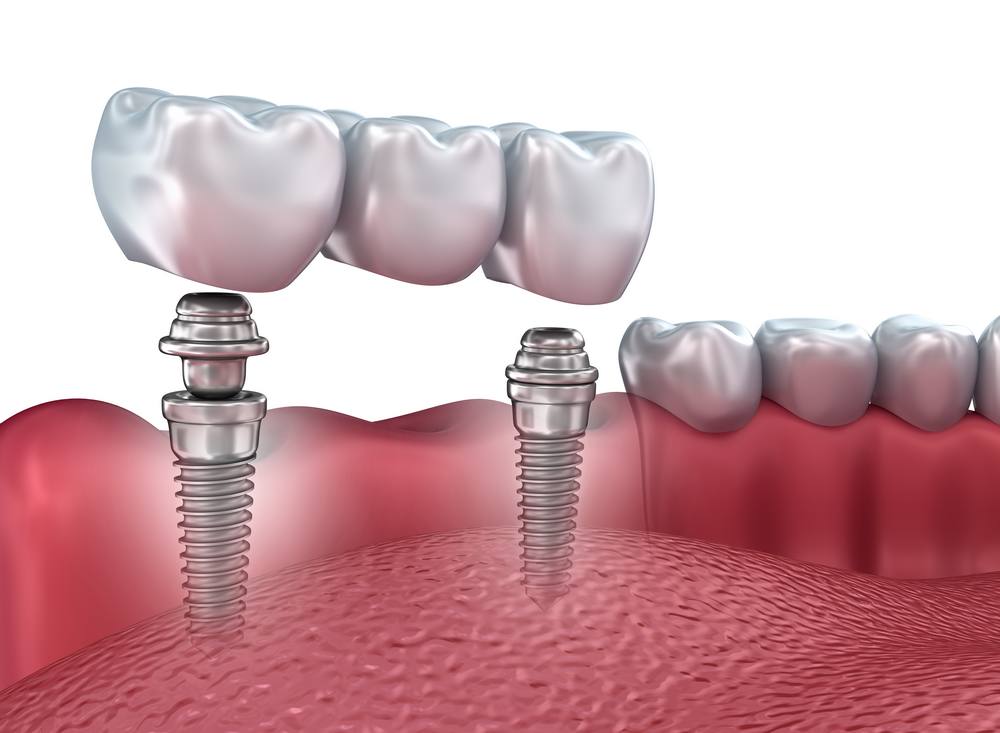 Colocación de un implante dental paso a paso