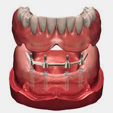 prótesis sobre implantes