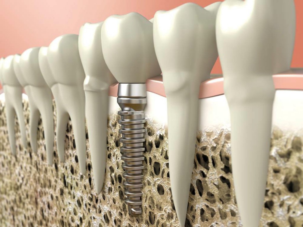 que-es-un-implante-dental