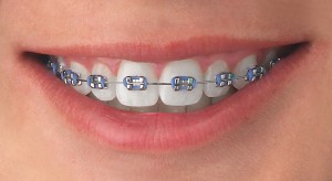 Brackets estéticos | Dentista | Endodoncia | Implantes dentales