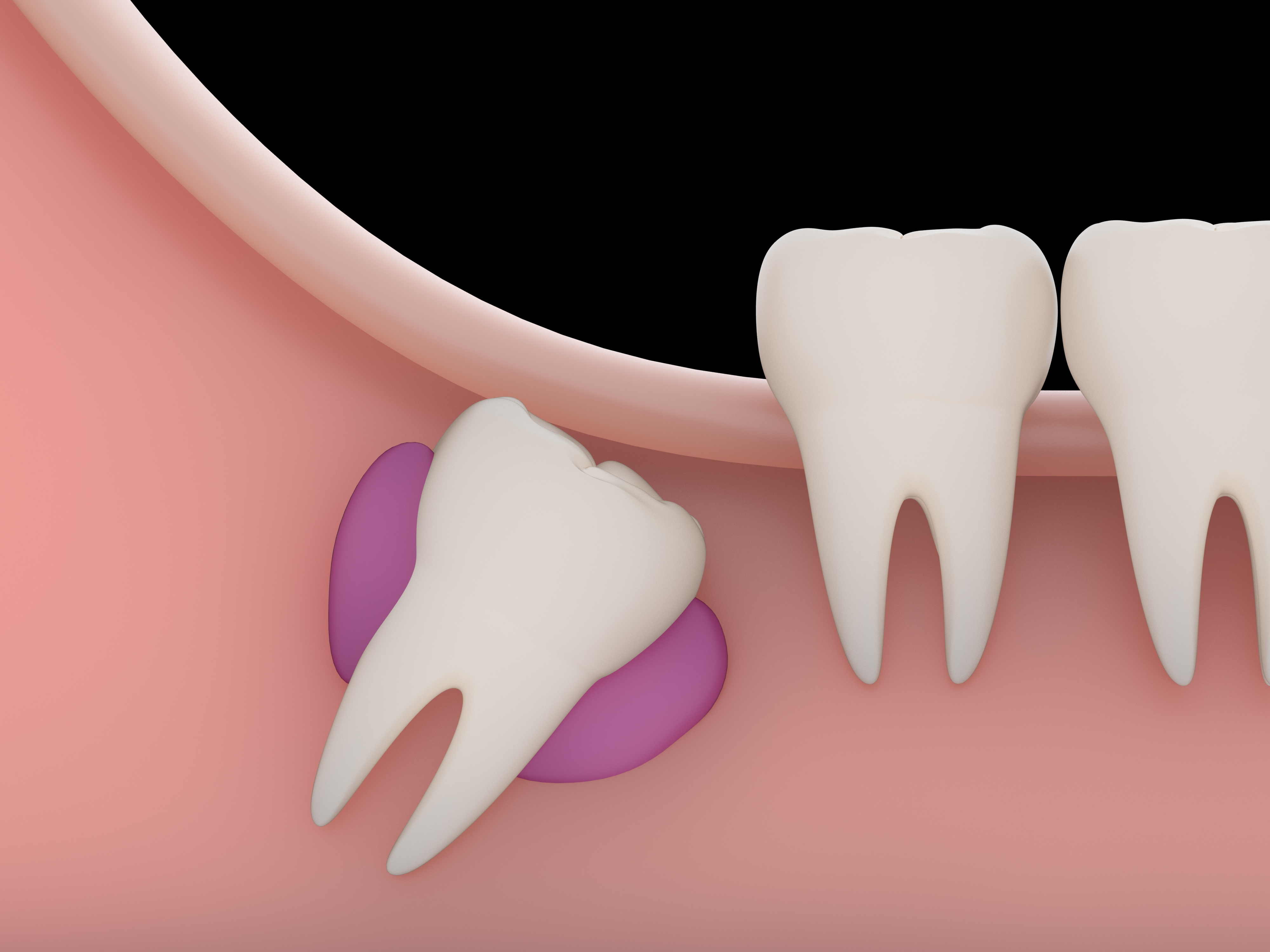 quistes dentarios