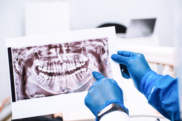Radiografía dental | Muela incluida | Salud Bucodental | Dentista en Madrid Río