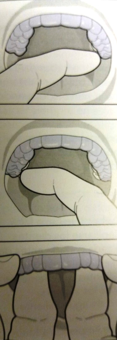 cuidados ortodoncia invisible