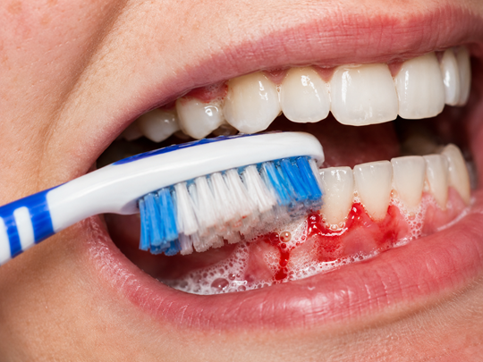 Imagen de sangrado de encía mientras se cepilla los dientes | Dolor de Encías | Salud Bucodental | Clínica Dental en Madrid Río