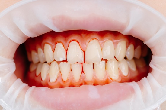 Imagen de dientes sangrando en las encías | Cuidar Implantes Dentales | Clínica Dental Larrañaga | Dentista