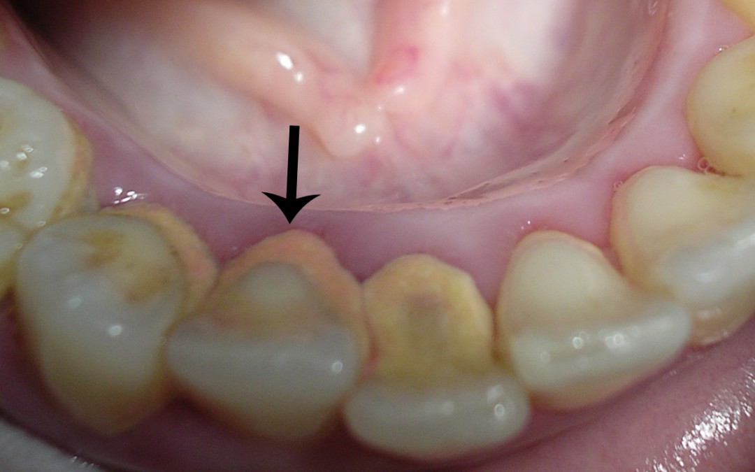 sostén Proporcional once Sarro en las encías - Clinica Dental Larrañaga