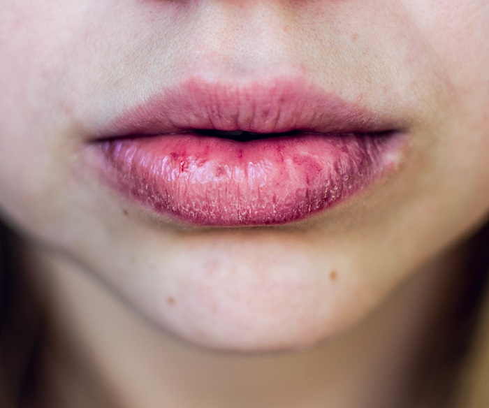 Sequedad bucal: cómo afecta a tus dientes y encías