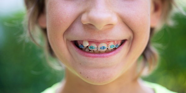 Sonrisa de un niño con brackets | revisiones dentales infantiles | Clínica Dental Madrid Río | Clínica Larrañaga | Vuelta al Cole