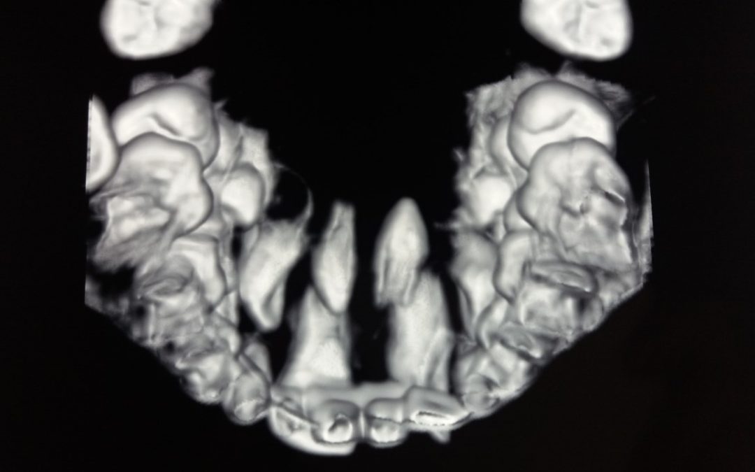 Dientes supernumerarios