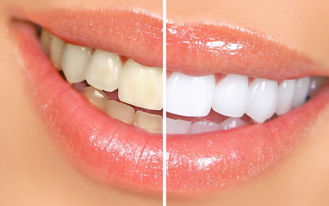 Tipos de blanqueamiento dental