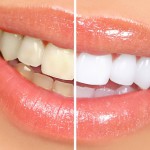 Tipos de blanqueamiento dental