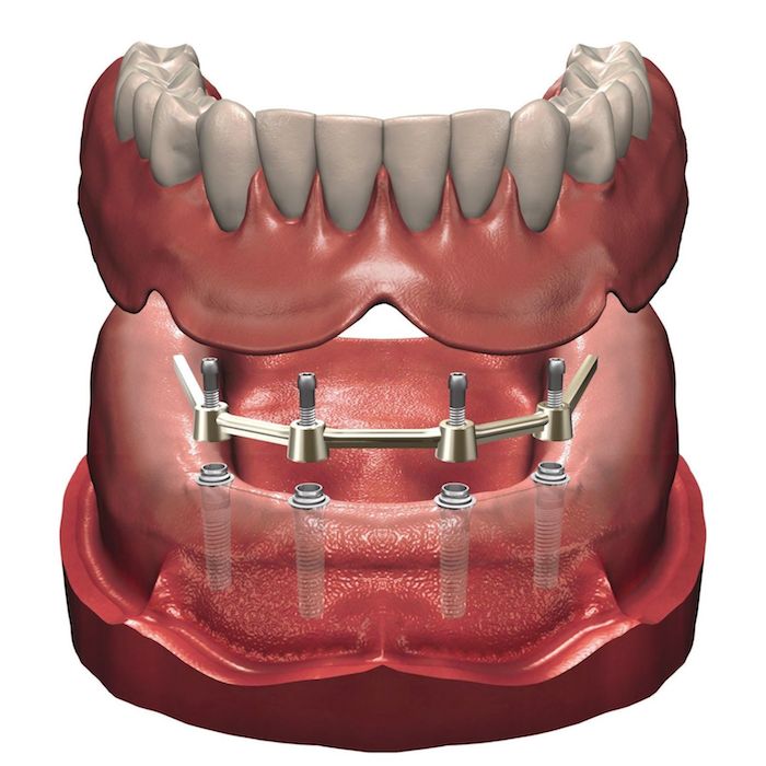 tipos_de_dentaduras_postizas_implantosoportadas