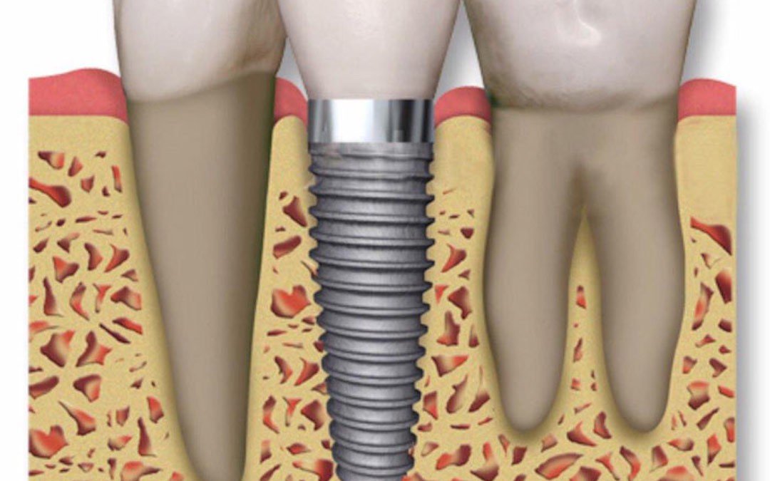 Tipos de implantes dentales