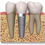 Implantes de carga inmediata