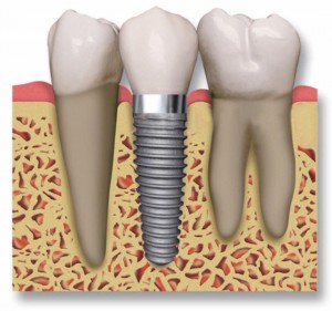 Implante dental | Dentista | Endodoncia | Implantes dentales