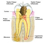 Caries. Síntomas