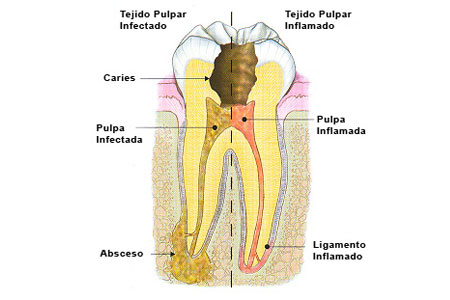 Caries. Síntomas