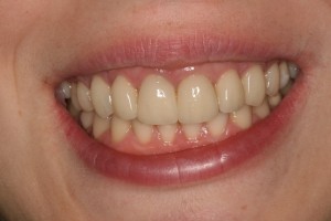 Dientes con coronas de zirconio | Tratamiento de periodoncia | Dentista implantes | Tratamiento del ronquido