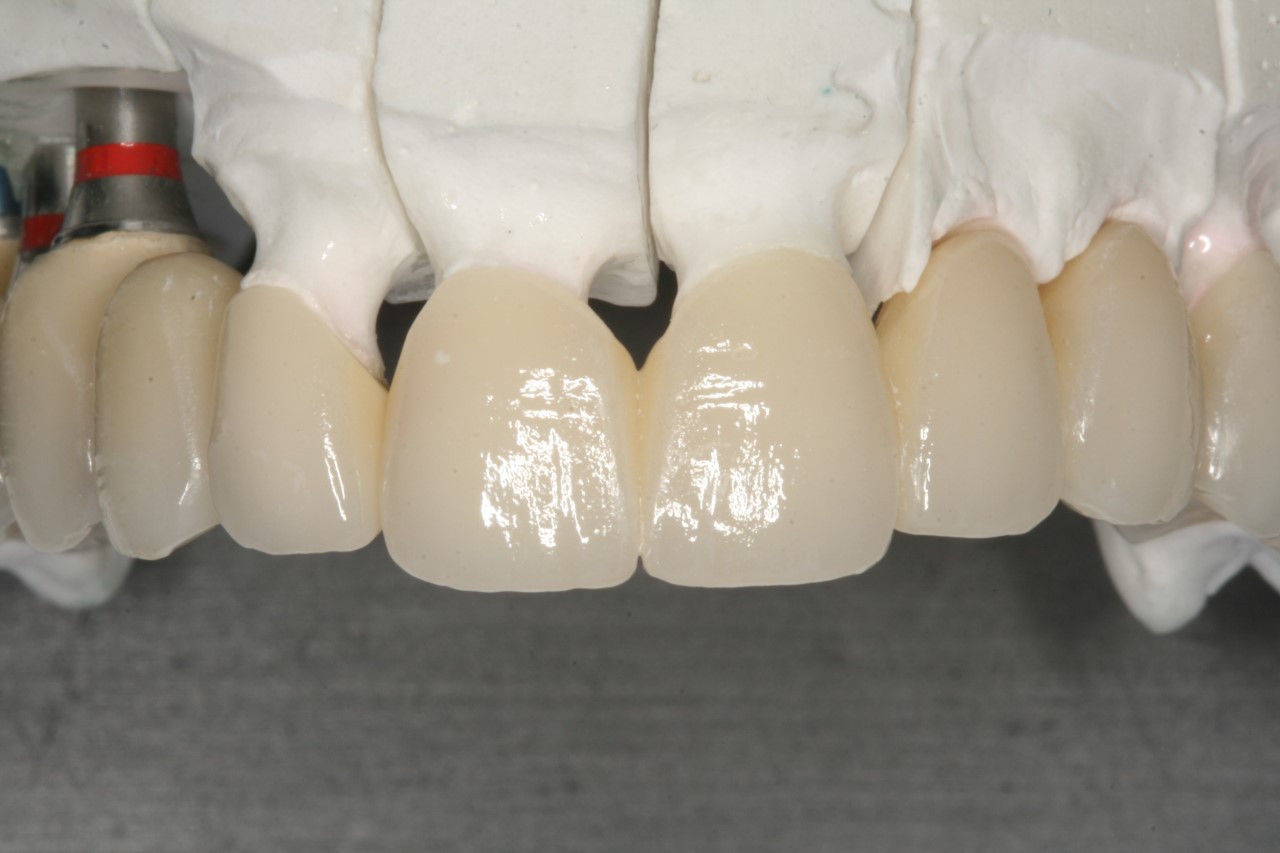 Zirconio o metal en coronas sobre implantes? – Estudi Dental Barcelona